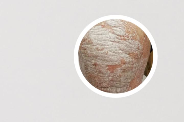 能根治银屑病吗