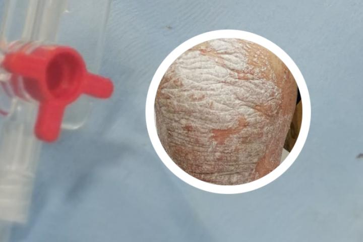 银屑病口服生物制剂