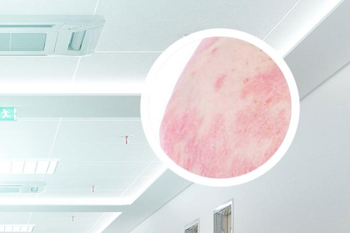 武汉银屑病去哪里看好