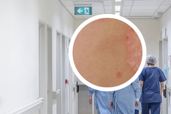 阿法赛特治疗银屑病