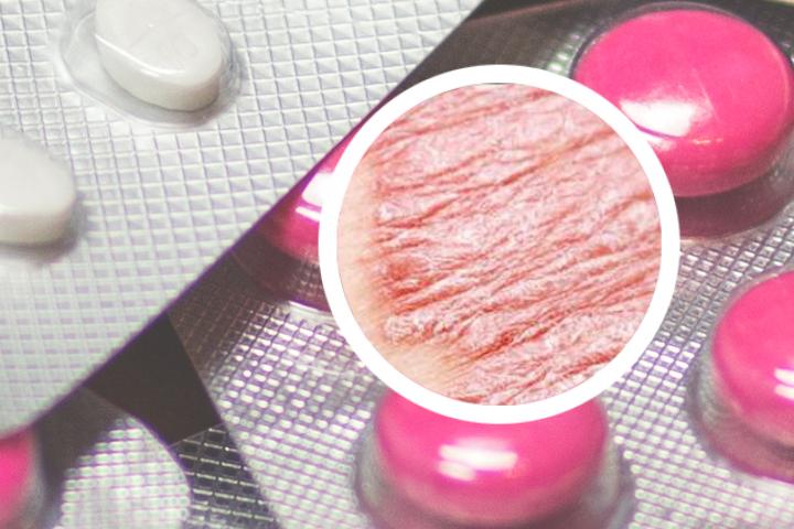 轻度牛皮癣自愈