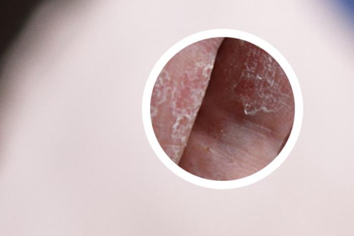 银屑病可以用艾草洗吗