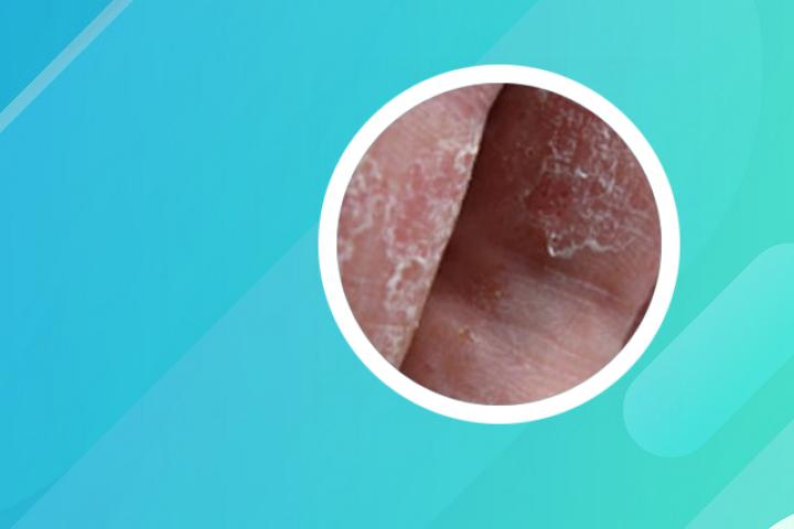 用啥办法可以治愈银屑病