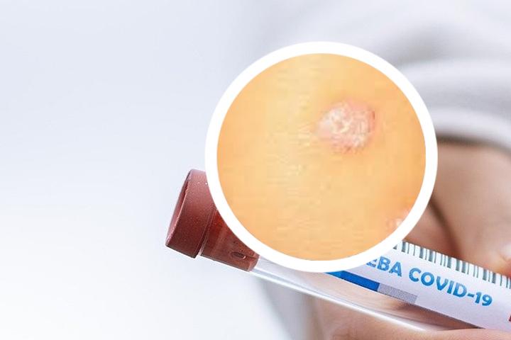 点滴银屑病吃不吃阿维a