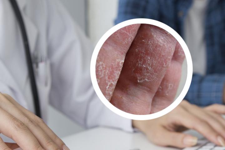 银屑病照完uvb发红