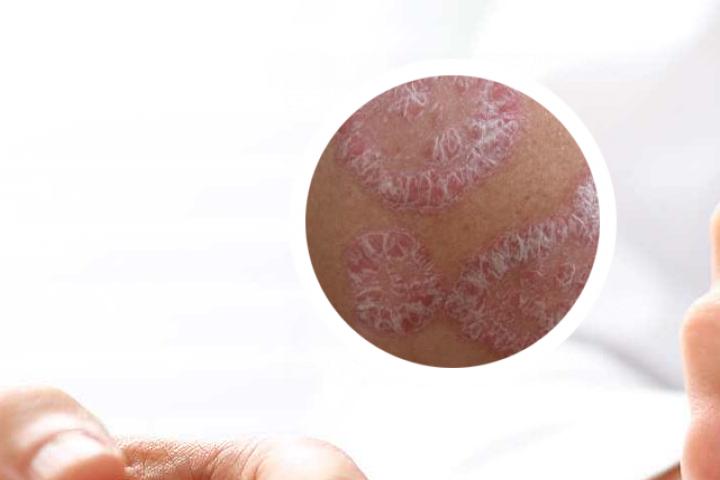 氯苯吡胺银屑病