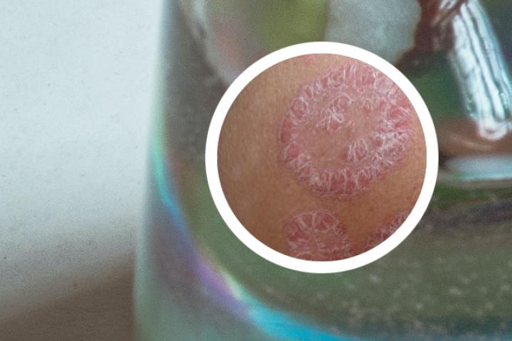 银屑病可以用维生素e保湿