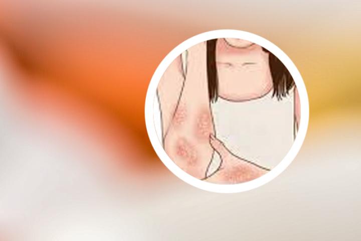 银屑病伤口艾滋病