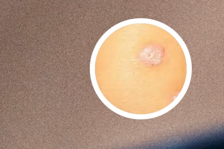 太原正规银屑病医院是哪家