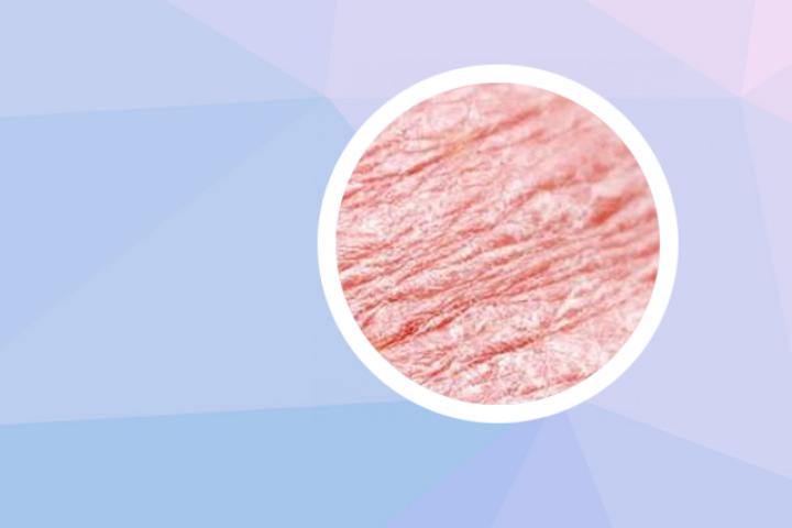 反向银屑病生物制剂