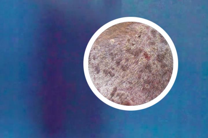 点滴型银屑病6个月才消退