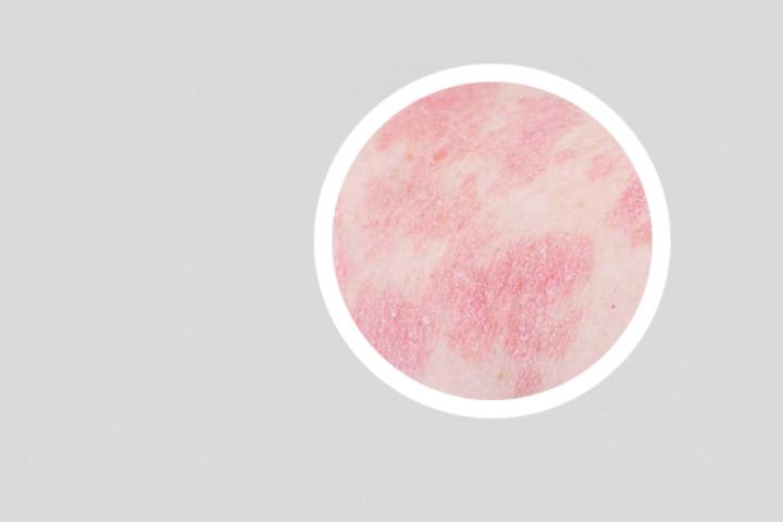 石家庄银屑病研究院