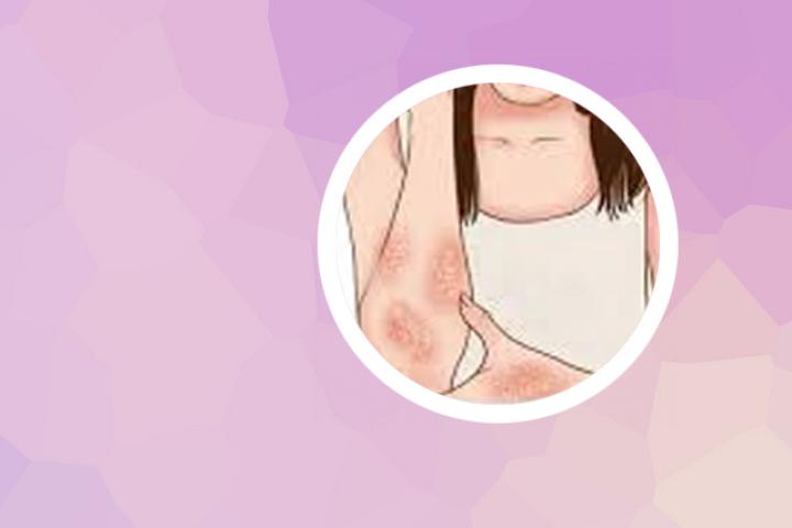 肠漏症和银屑病有关联吗