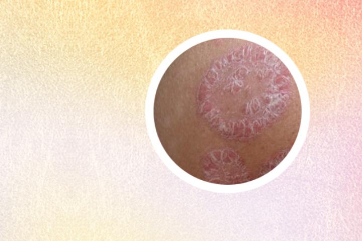 300元治好银屑病