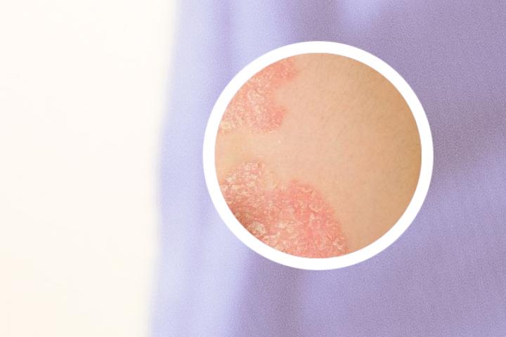 请问昆明延安医院有银屑病专家吗