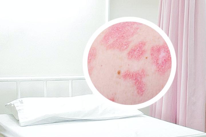 丘疹型银屑病