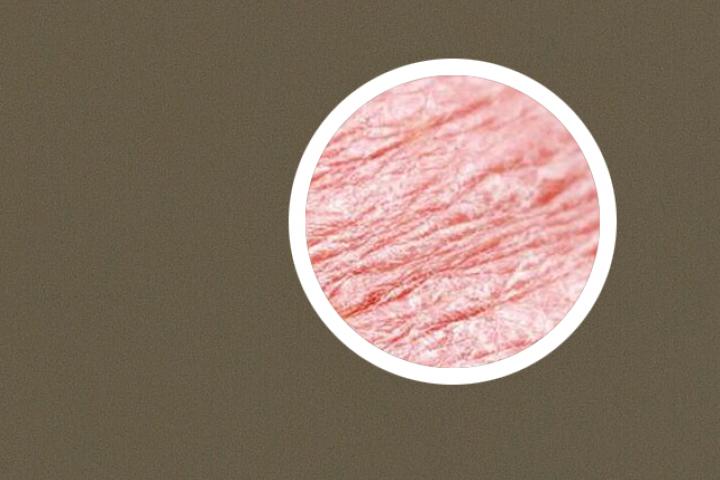 银屑病最便宜生物制剂