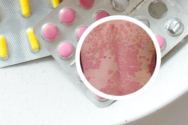 全国治疗银屑病的专家