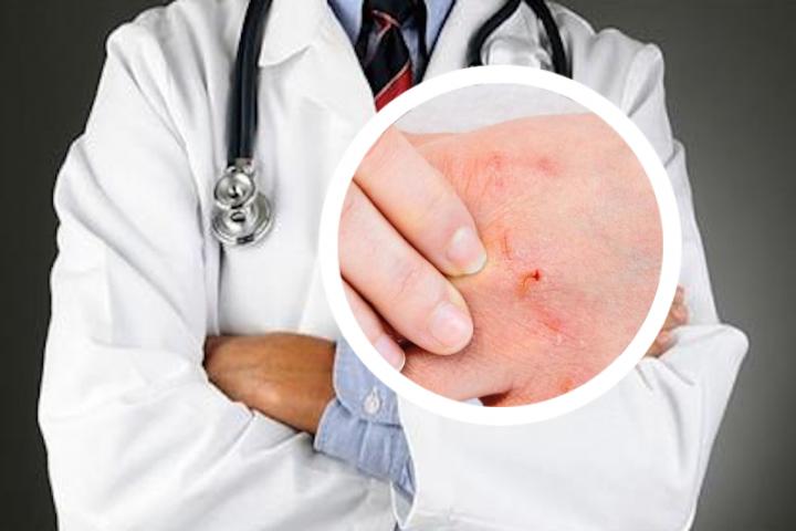 银屑病患者的健康教育