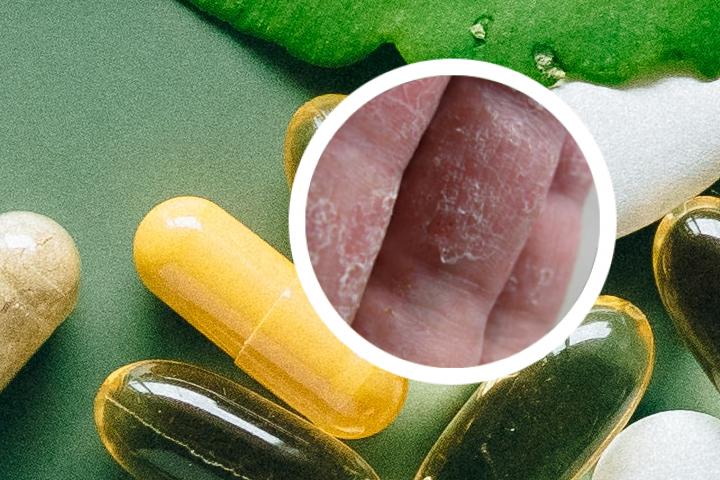 银屑病能用手挠吗