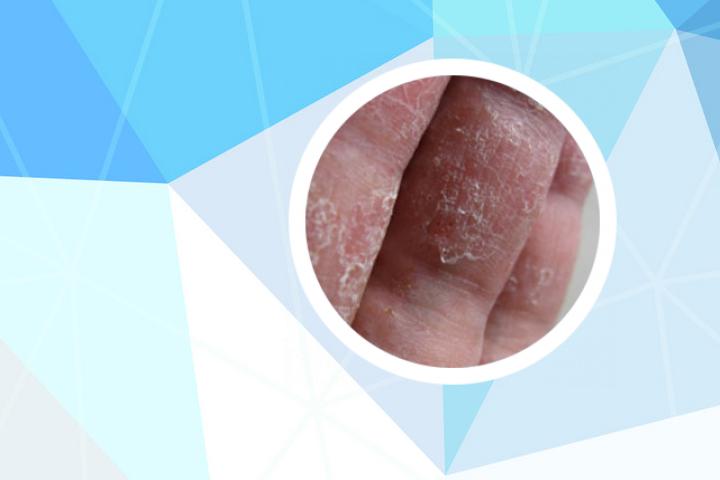 氯霉素和碘伏治疗牛皮癣吗