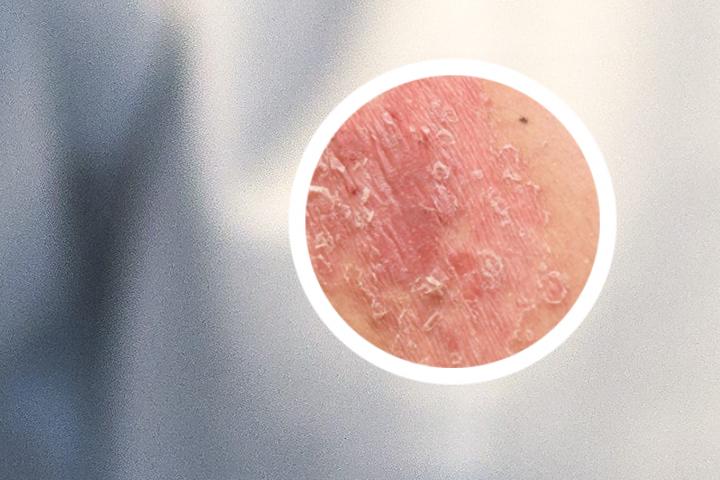 银屑病用药刺激了之后