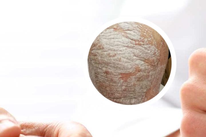 艾草熬水洗治疗银屑病案例