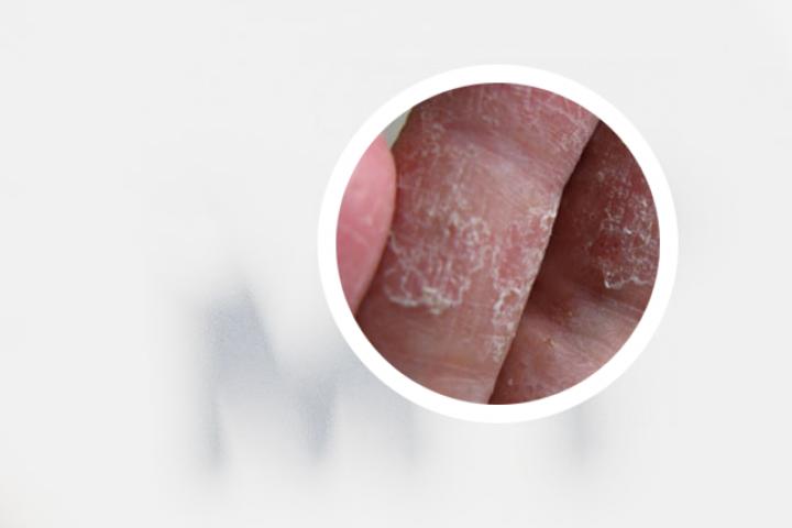 治疗银屑病前后对比图