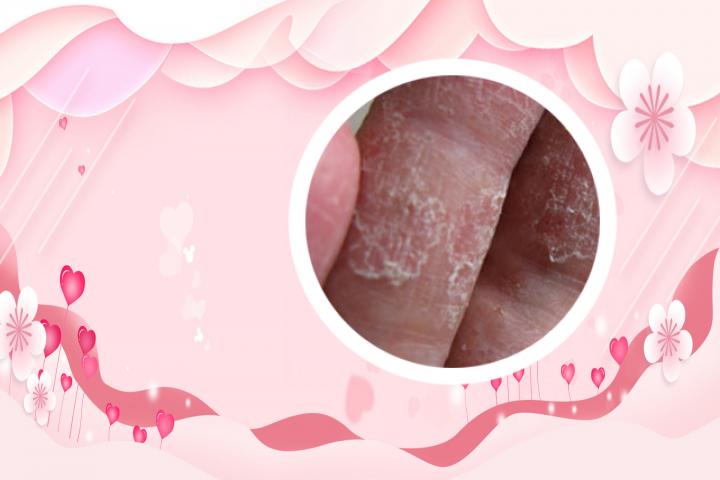 牛皮癣医院做301是什么