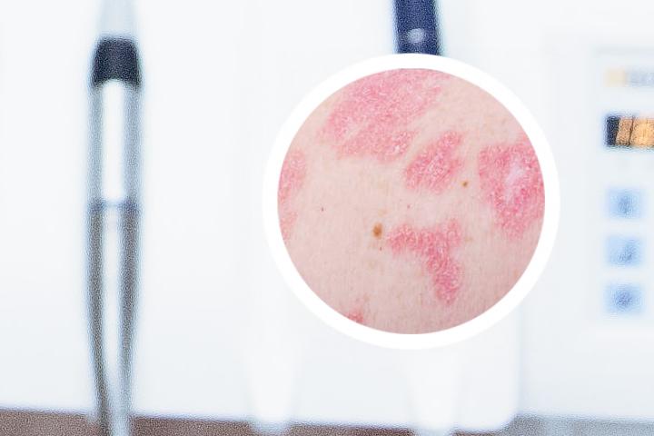 银屑病自制药水