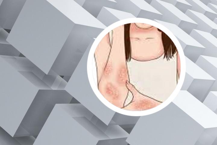 银屑病泡澡严重了