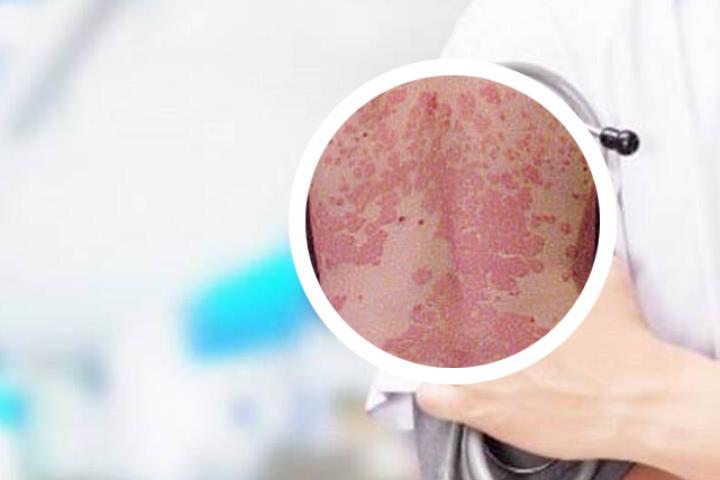 请问镇江有哪些专业的银屑病医院可以治疗银屑病呢