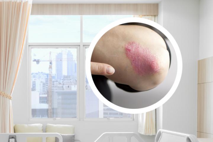 光疗能治好银屑病吗