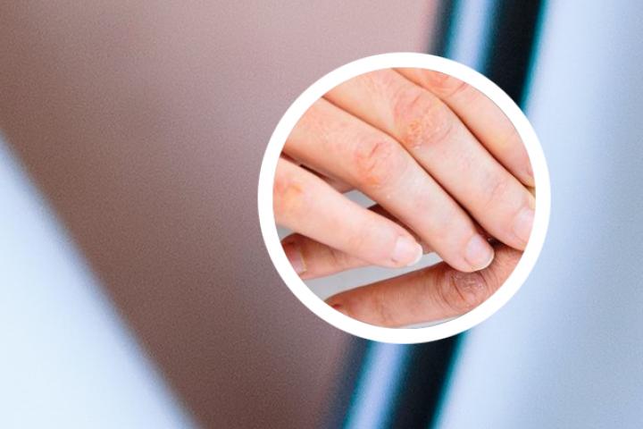 转移因子胶囊银屑病