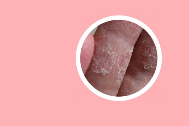 孙青齐鲁医院治疗银屑病