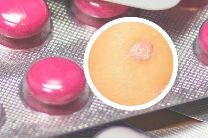吃蜂王浆能治愈银屑病吗