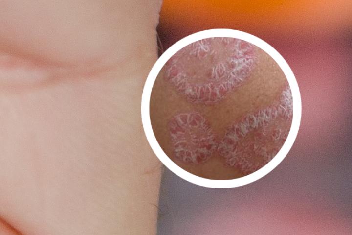 银屑病光治疗