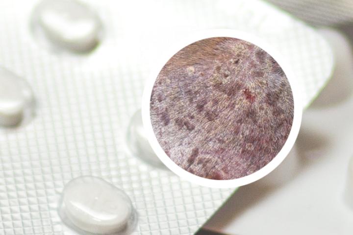 牛皮癣湿疹药膏日本进口