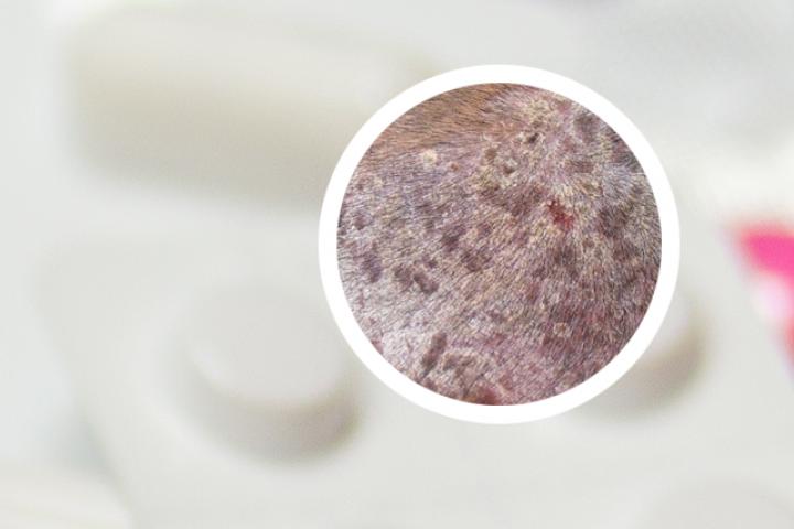 丝瓜治牛皮癣偏方