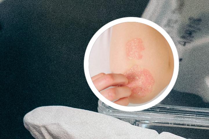为什么身上的银屑病自己消失了