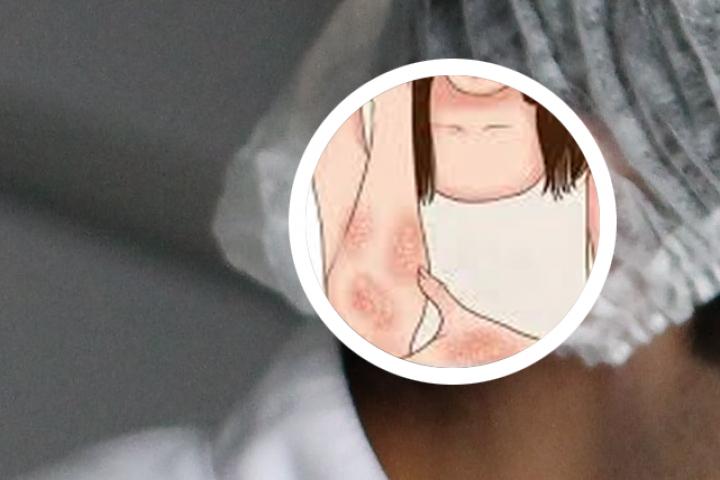 河池治疗牛皮癣
