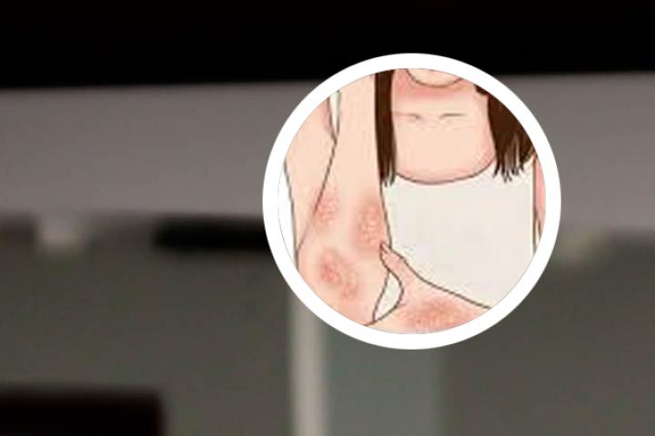山西针灸能否治疗银屑病
