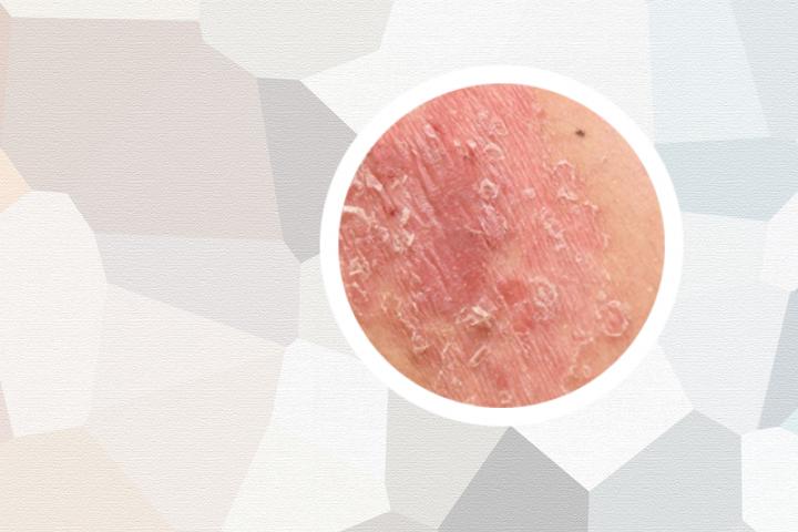 银屑病可以拔火罐吗