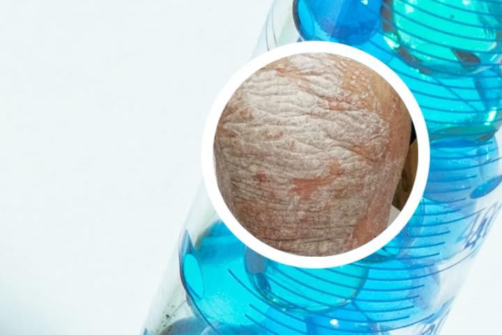银屑病引起的骶髂关节炎