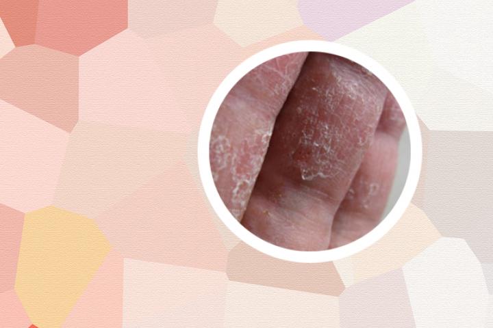 艾滋病和银屑病