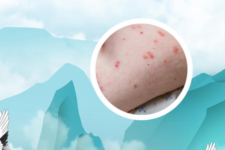 银屑病跟hiv有关系吗