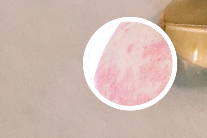 银屑病前后对比照片