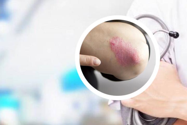 谁能告诉我4岁宝宝银屑病怎么办