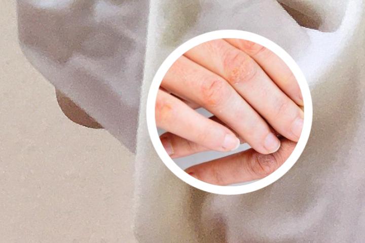 哺乳期牛皮癣可以治疗么