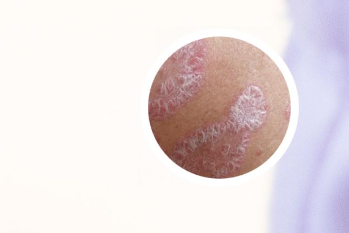 掌跖脓疱病不一定是牛皮癣
